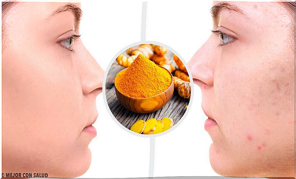 5 face masks with turmeric to remove acne scars