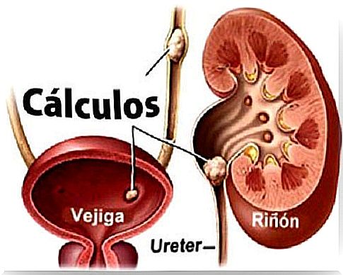 Kidney stones