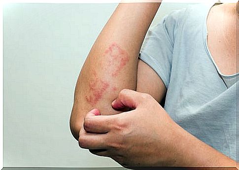 Man with psoriasis scratching his arm