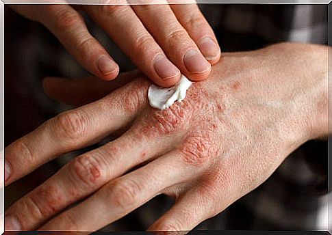 Man applying cream to his hand