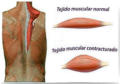 How a muscle contracture is formed