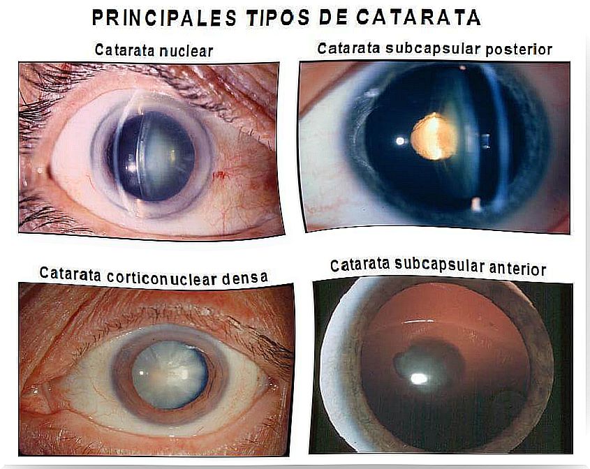 cataract types