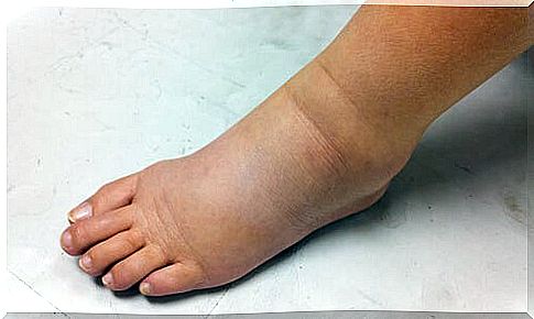 edema in the foot