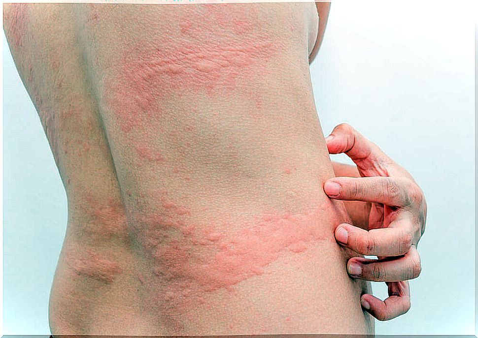 Urticaria