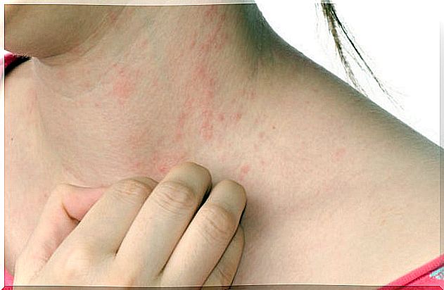 Woman with urticaria on the neck.