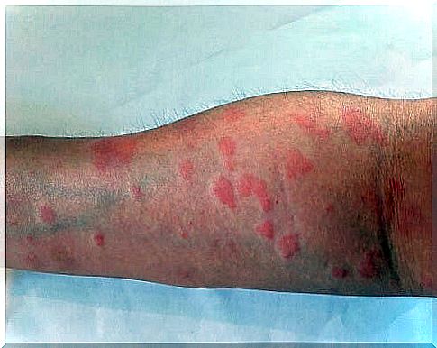 Causes of erythema