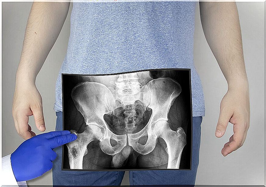 X-ray of the pelvis of a person.