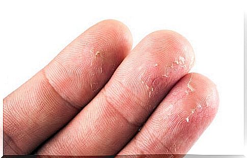 Three fingers of a hand with eczema.