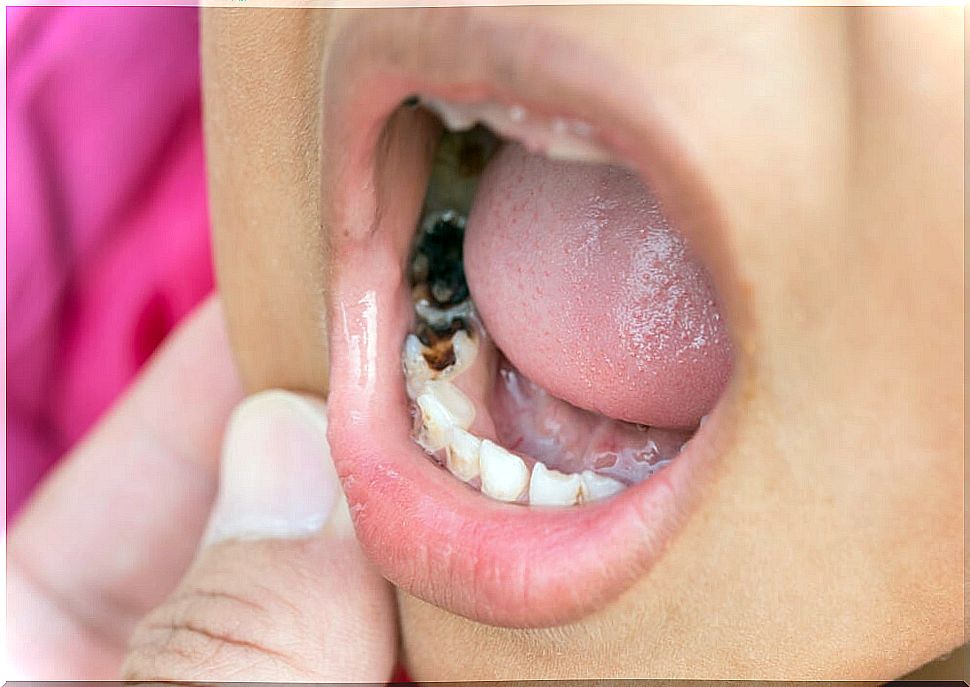 Child with cavities.