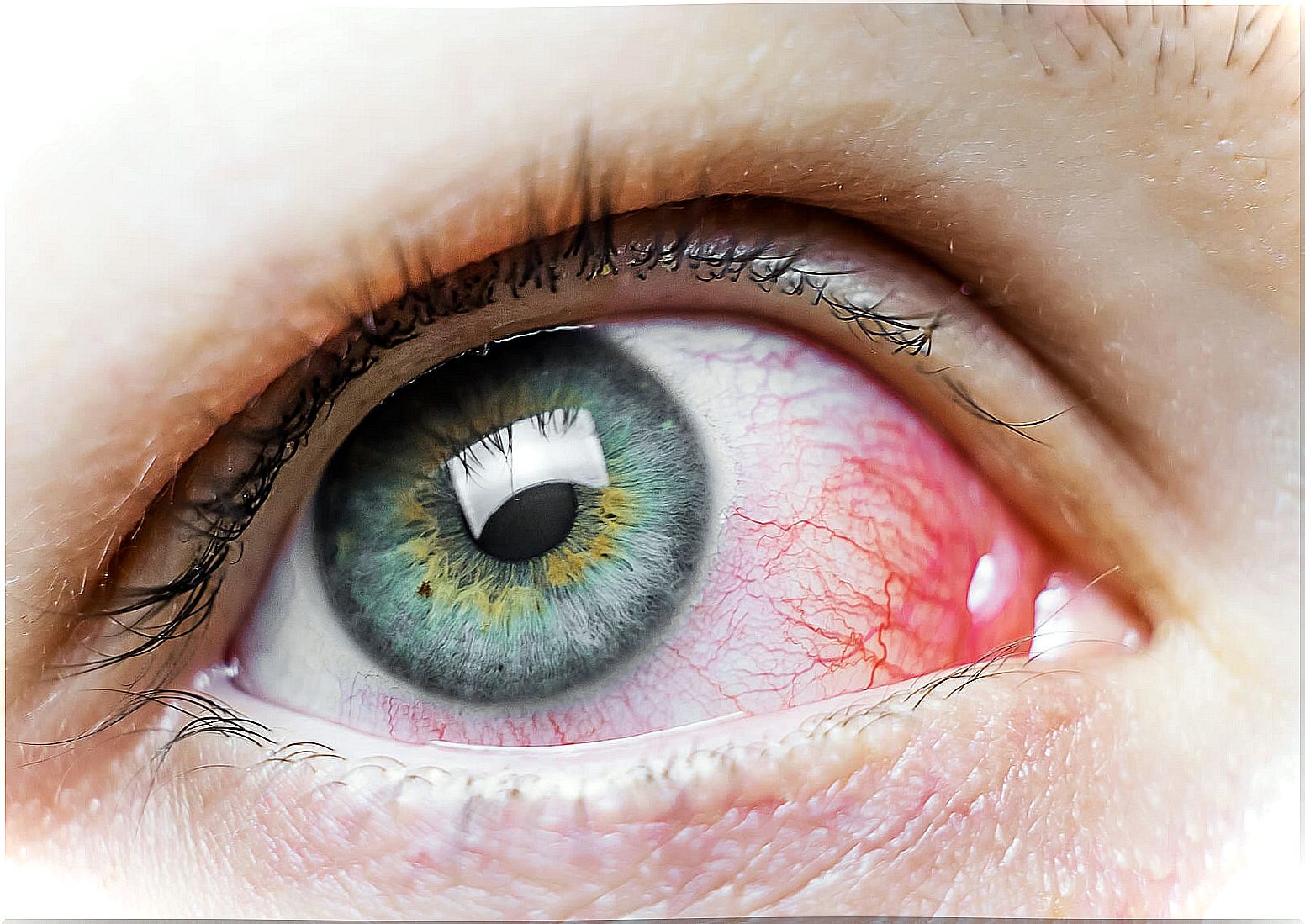 Eyestrain can be a cause of red eye spots.