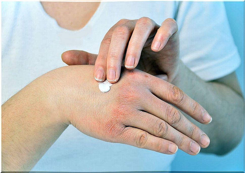 What are chilblains?  Discover 7 home remedies to treat them