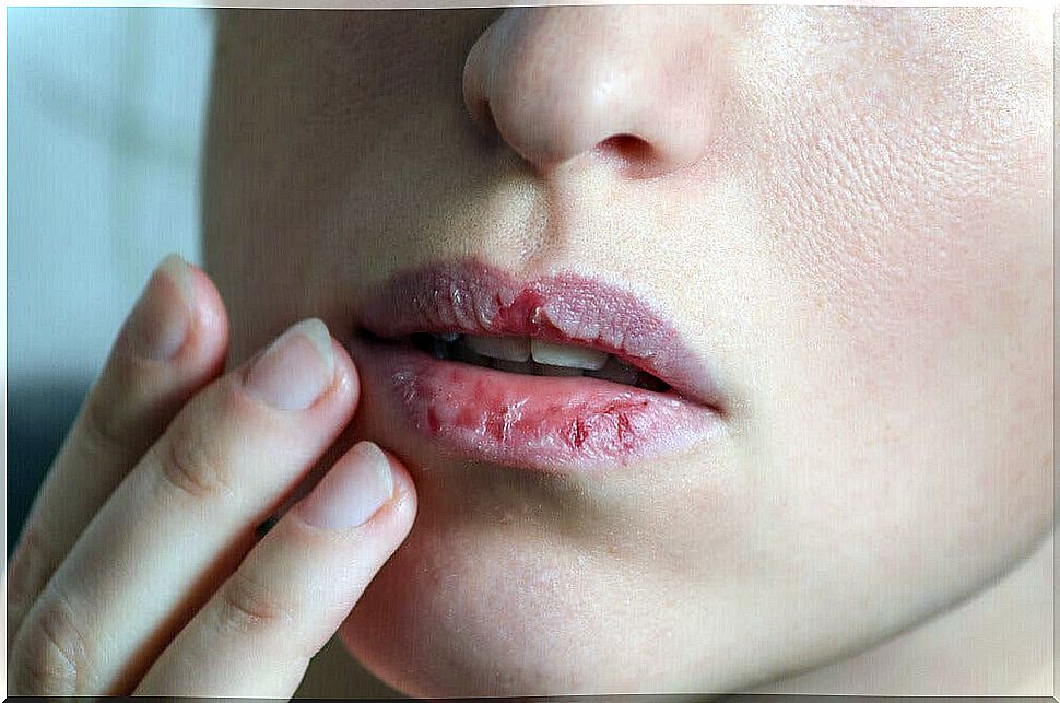 Dry lips