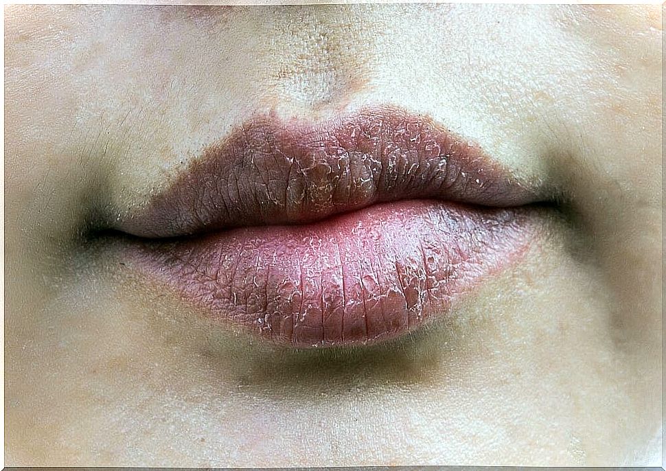 Dry lips due to dehydration.