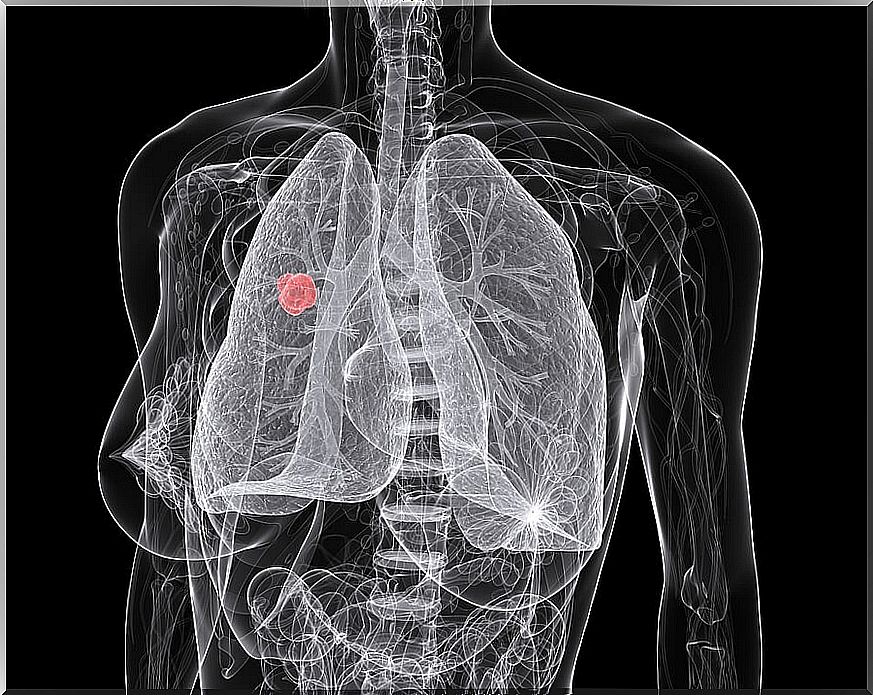 Lung cancer in women.